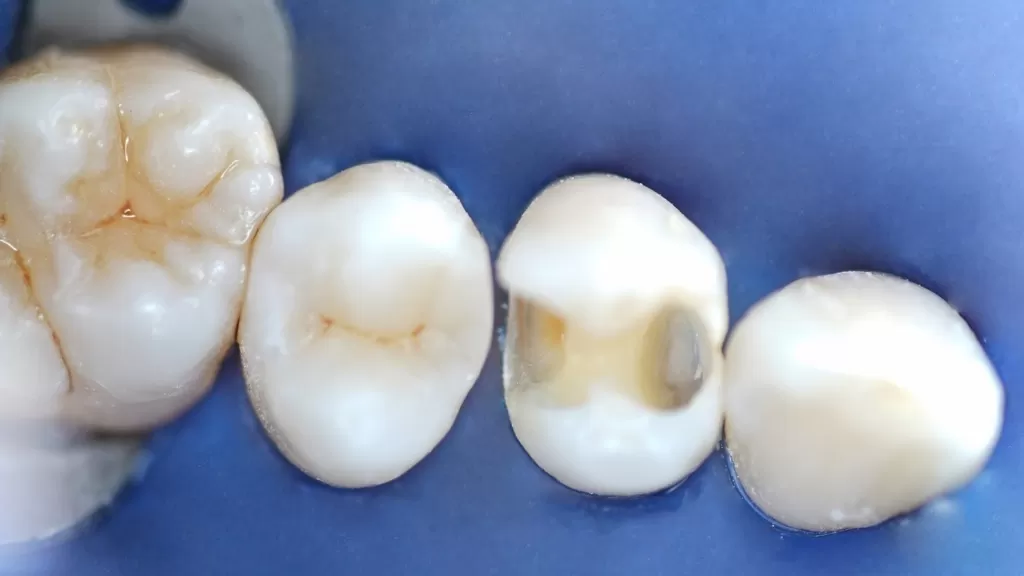 Восстановление анатомии формы зуба 2.5 в процессе художественной реставрации. Лечащий врач Меликов Азер Фуадович